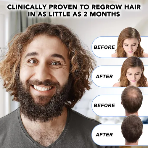Miniatura 4 de Minoxidil para hombres - 5% extra fuerte crecimiento del cabello para hombres tratamiento-5% solución tópica aplicador gotero incluido -Minoxidil