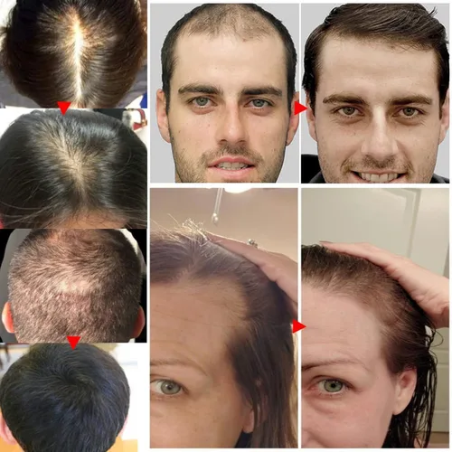 Miniatura 6 de Biotin - Suero para el crecimiento del cabello para el tratamiento de la pérdida y el crecimiento del cabello, aceite esencial de jengibre natural