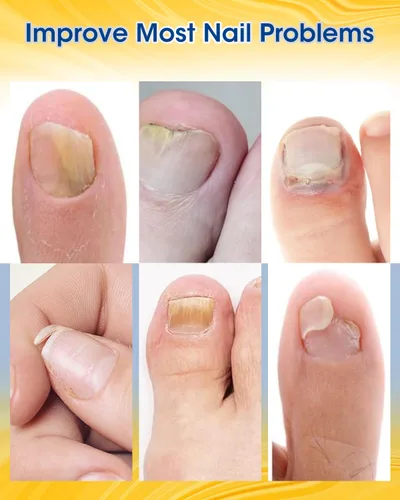 Miniatura 3 de MYMULIKE Parches de reparación de uñas extra fuertes, 28 unidades, reparación de uñas para uñas dañadas, parches de renovación de uñas nocturnas