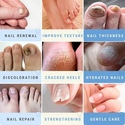 Miniatura 4 de Urea 50% Gel de uñas – Suaviza los callos agrietados del talón y las uñas gruesas de los pies – Repara uñas dañadas, amarillas y decoloradas