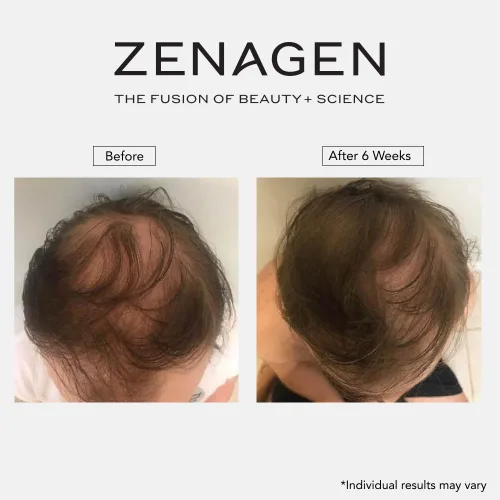 Miniatura 11 de Zenagen Revolve - Tratamiento de pérdida de cabello para hombres