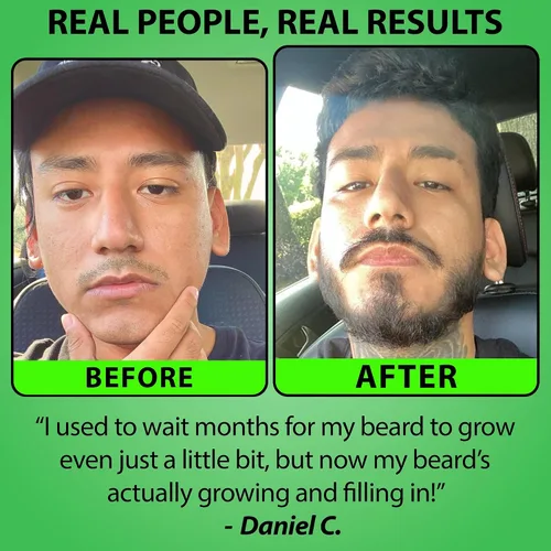 Miniatura 3 de Minoxidil para el crecimiento de la barba: suero al 5% con 2 veces biotina y agua de arroz, promueve el cabello facial más grueso y lleno, ideal
