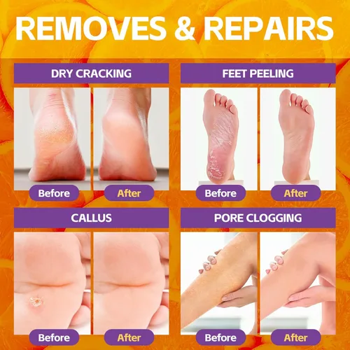 Miniatura 3 de Remojo de pies de pedicura, baño de pies de spa, kit de pedicura, baño de pies de burbujas para pies agrietados y cansados y secos, pies de atletas