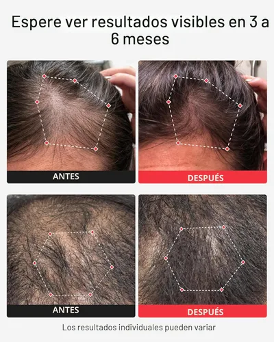 Miniatura 2 de iRestore - Sistema para crecimiento del cabello + baterías recargables, gorra láser aprobada por la FDA (Administración de Alimentos y Medicamentos)