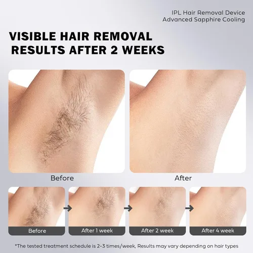 Miniatura 4 de Depilación láser para mujeres y hombres, depilación láser IPL, sin dolor, permanente, uso en el hogar, depilación facial para mujeres, luces duales