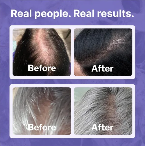 Miniatura 4 de Shapiro MD Hair Growth Experts Minoxidil Solución tópica al 2% para mujeres, el suero promueve el recrecimiento del cabello al reactivar