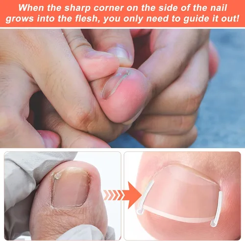 Miniatura 4 de (50+2) Juego de corrector de uñas encarnadas con cortaúñas, kit profesional de eliminación de uñas encarnadas sin dolor con levantador, tira de uñas