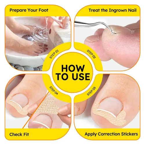 Miniatura 4 de Tratamiento de uñas encarnadas, corrector de uñas curvadas transpirables, tiras correctoras de uñas encarnadas con lima y levantador, kit