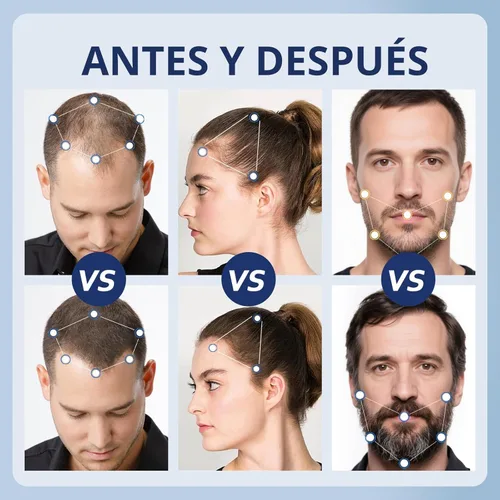 Miniatura 4 de Advanced 5% Minoxidil para mujeres suero de crecimiento del cabello, minoxidil para hombres extra fuerte, solución líquida de minoxidil para cabello