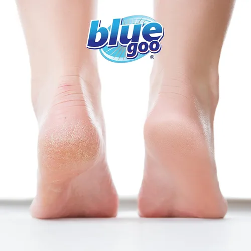 Miniatura 2 de Blue Goo Talones agrietados y manos secas suavizante para pies secos, manos, hidratante y suavizante, hidratante, alivio de la sequedad, 2 onzas