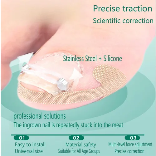 Miniatura 3 de Kit corrector de uñas encarnadas para hombres y mujeres, herramienta de uñas encarnadas, 2 clips de acero inoxidable, tiras de uñas curvas
