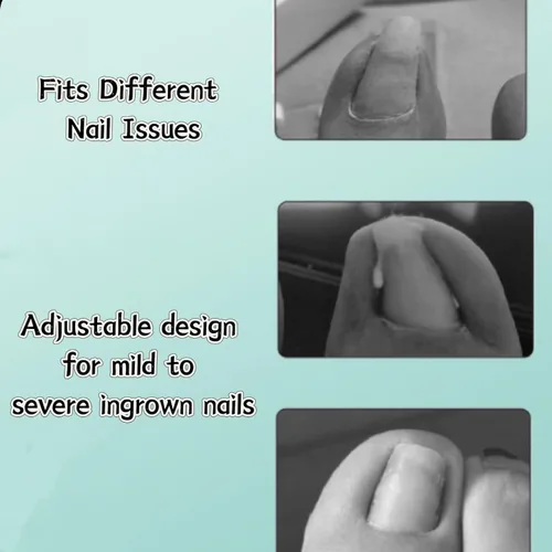 Miniatura 9 de Kit corrector de uñas encarnadas para hombres y mujeres, herramienta de uñas encarnadas, 2 clips de acero inoxidable, tiras de uñas curvas