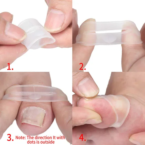Miniatura 5 de Corrector de uñas encarnadas, 2 piezas de herramienta de corrección de uñas encarnadas de silicona, corrector de uñas encarnadas, tratamiento