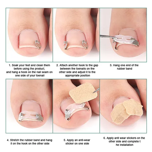 Miniatura 5 de Juego de herramientas de corrección de uñas encarnadas, 2 clips de inserción de acero inoxidable para tratamiento de uñas encarnadas, tiras