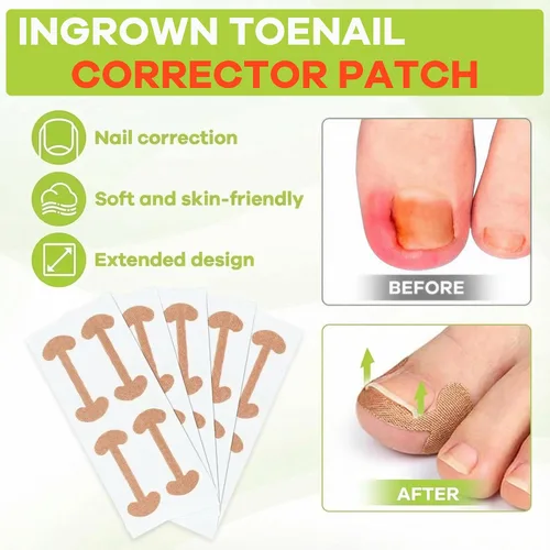 Miniatura 3 de Kit corrector de uñas encarnadas, herramientas de uñas, tiras de corrección transpirables con herramientas de levantamiento de uñas, cortaúñas