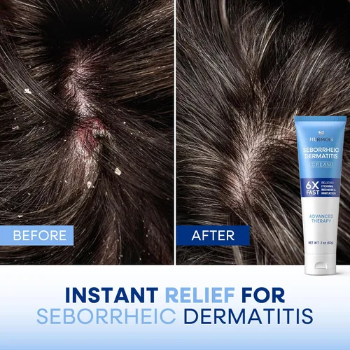 Miniatura 4 de Hermon Crema para el tratamiento del cuero cabelludo para la dermatitis seborreica: calmante picazón enrojecimiento Escalado de la dermatitis
