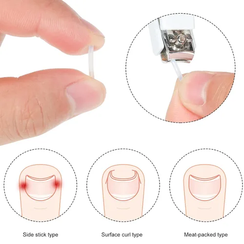 Miniatura 4 de 60 tiras correctoras de uñas encarnadas, corrección de uñas encarnadas, corrección de uñas, clip para enderezar uñas, parche curvo corrector de uñas