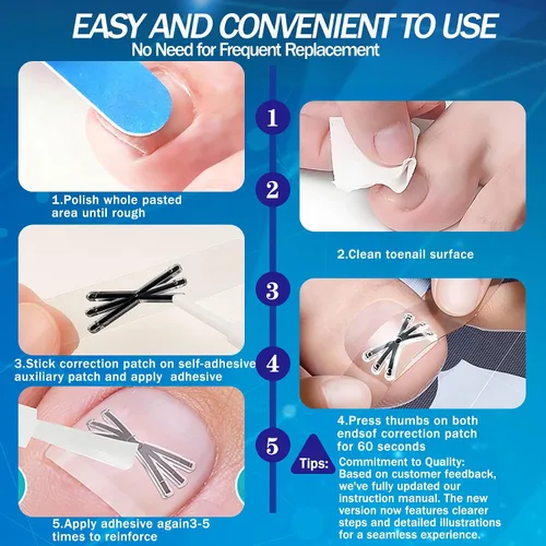 Miniatura 6 de Tratamiento de uñas encarnadas con forma mejorada de 6 ángulos, corrector de uñas encarnadas de aleación de titanio para un alivio rápido, kit