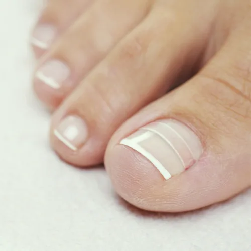 Miniatura 7 de Tratamiento del hogar para uñas encarnadas CurveCorrect