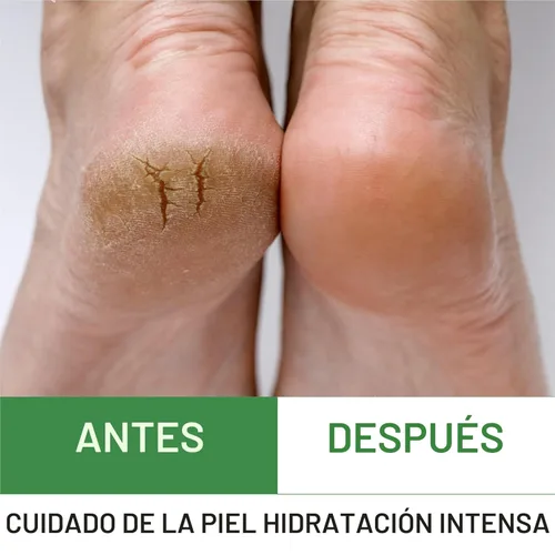 Miniatura 6 de Crema para los pies de urea al 40 %. 4 onzas, mejor removedor de callos, hidrata y rehidrata los pies, rodillas y codos, para la piel agrietada