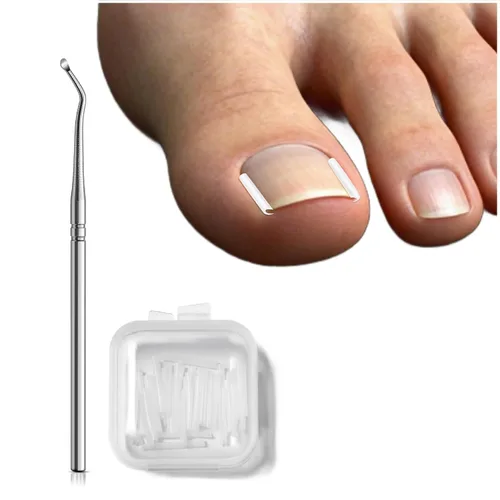 FVION Juego de corrector de uñas encarnadas – 40 tiras alisadoras de uñas encarnadas sin dolor con levantador de uñas de los pies – Solución eficaz