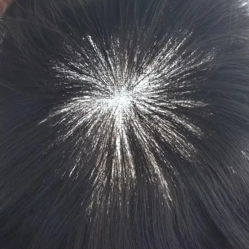 Miniatura 4 de FACE MIRACLE - Tupé frontal de encaje francés para hombres, sistema de reemplazo de cabello humano de encaje con pieza de pelo de poliuretano