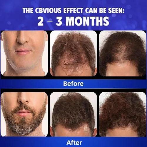 Miniatura 2 de Suero de regeneración del cabello de minoxidil al 5% para mujeres y hombres, aceite de romero, biotina, aceite de batana, tratamiento tópico