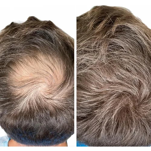 Voloria Parche para el cabello de punto calvo para hombres, 3.15 x 3.15 pulgadas, parches de pelo completo de poliuretano para cubrir la base de la