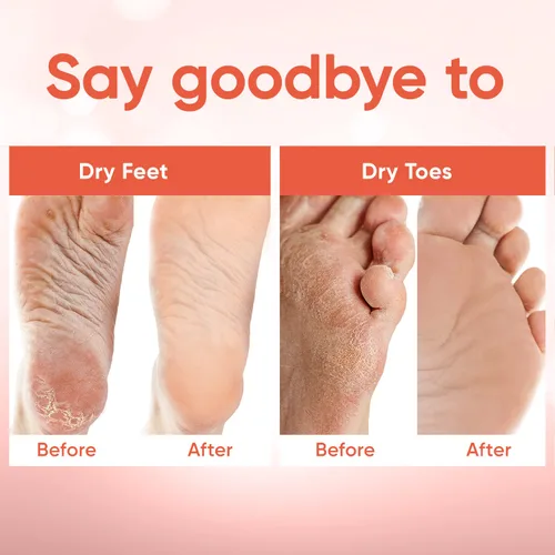 Miniatura 4 de Máscara exfoliante para pies - Máscara para pies con piel suave como la de un bebé - Elimina la piel muerta, pies secos, agrietados y callos, spa