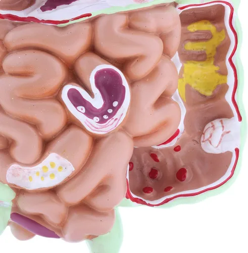 Miniatura 4 de KESOTO Modelo de Patología Gastrointestinal Humana Modelo Coronal Gástrico del Tracto Digestivo para Estudiantes Escolares Aprendizaje