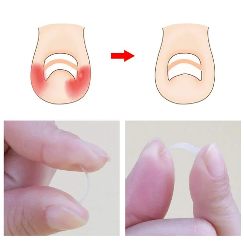 Miniatura 3 de Tiras correctoras de uñas encarnadas Brace 10 unids/botella enderezadora clip curvado BS Brace uñas de los pies gruesa corrección herramienta de pie