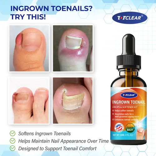 Miniatura 2 de Alivio de Uñas Encarnadas: Herramienta para Uñas Encarnadas para Hombres Mujeres - Kit de Eliminación de Uñas Encarnadas - Gotas Correctoras de Uñas