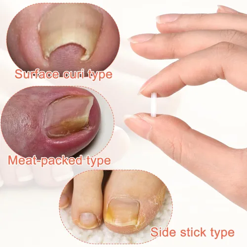 Miniatura 5 de (50+2) Juego de corrector de uñas encarnadas con cortaúñas, kit profesional de eliminación de uñas encarnadas sin dolor con levantador, tira de uñas