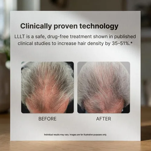Miniatura 4 de Alpha Hair Growth Laser Cap (136 láseres) Dispositivo de crecimiento láser aprobado por la FDA para hombres y mujeres, tecnología láser SMT, salida