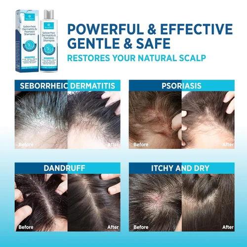 Miniatura 3 de Roycederm Set de champú y acondicionador para dermatitis seborreica y psoriasis, tratamiento eficaz del cuero cabelludo para foliculitis, psoriasis