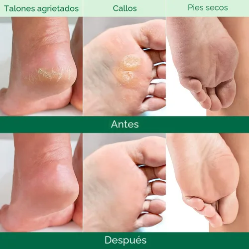 Miniatura 3 de PLANTIFIQUE Mascarilla exfoliante para pies, paquete de 2 para hombres Dermatológicamente probada, repara talones y elimina piel seca muerta