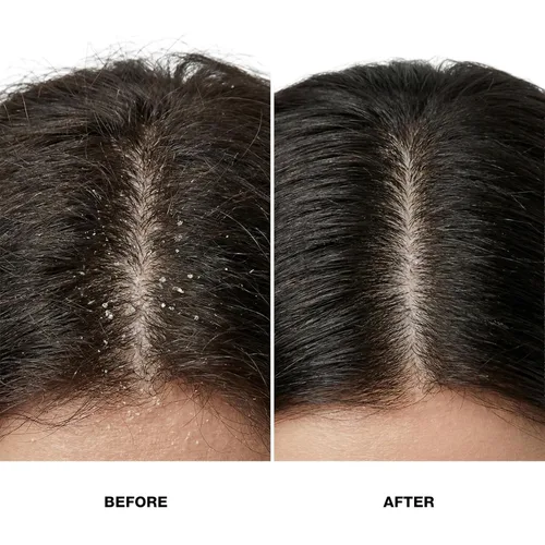 Miniatura 4 de GK HAIR Champú anticaspa que deja tu cuero cabelludo fresco y suave - Champú sin sulfato para cabello seco dañado para hombres y mujeres, 8.5 onzas