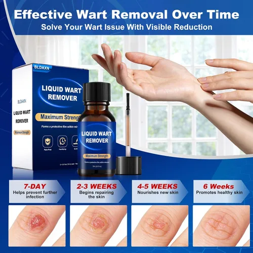 Miniatura 6 de Fast-Acting Wart Remover Freeze Off & Corn Remover, 2-Pack 30 ml Salicylic Acid Plantar Wart Remover for Feet, Hands & Skin - Professional Wart