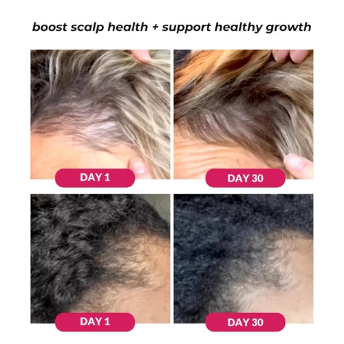Miniatura 2 de Love Ur Curls - Suero de cuero cabelludo saludable activador del crecimiento del cabello, extractos de cúrcuma y albahaca para una hidratación