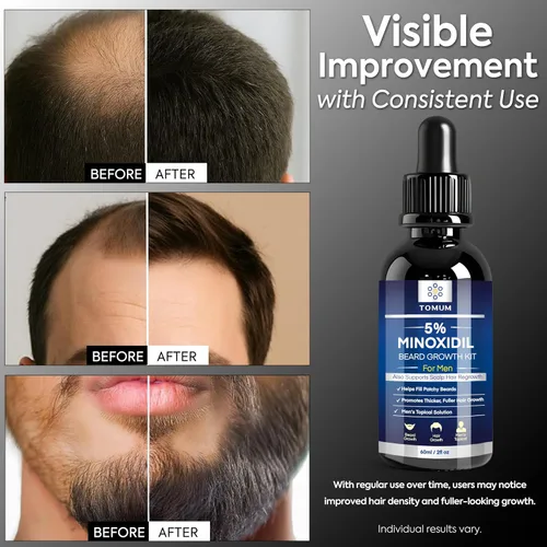 Miniatura 3 de TOMUM Kit de crecimiento de barba de minoxidil al 5% para hombres, suero para el crecimiento del cabello y la barba, ayuda a llenar las barbas