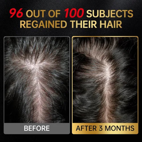 Miniatura 4 de Solución tópica de minoxidil USP 5% para hombres y mujeres - Tratamiento de crecimiento capilar OTC, fármaco monográfico de la FDA, fórmula no grasa