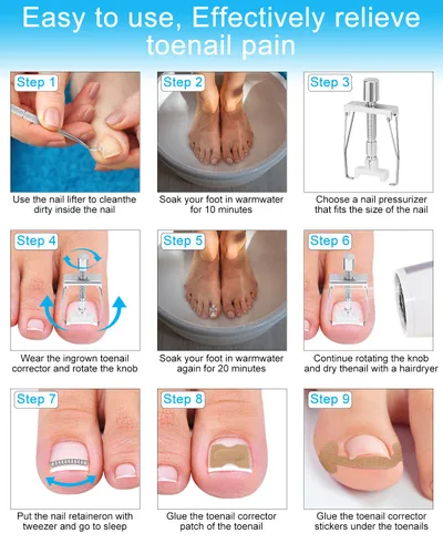 Miniatura 5 de Kit de eliminación de uñas encarnadas, tratamiento de uñas encarnadas, herramientas correctoras de uñas encarnadas vienen con soportes para uñas