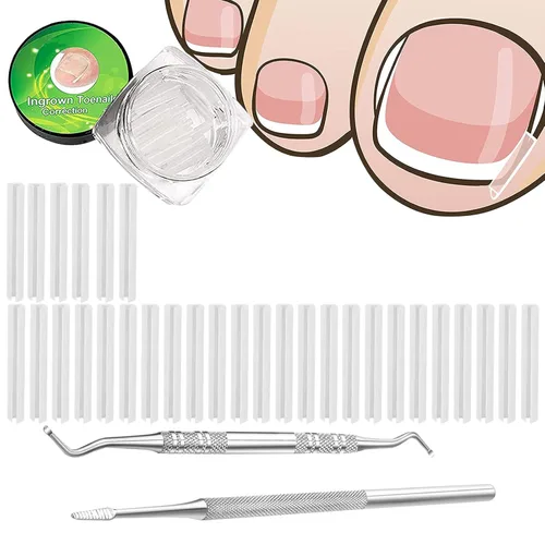 (30+2) Kit de tratamiento de corrección de uñas encarnadas, 30 tiras correctoras de uñas encarnadas, herramienta de pedicura de uñas encarnadas,