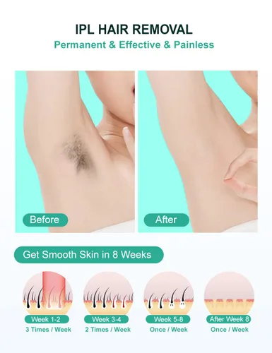 Miniatura 5 de At-Home - Dispositivo de depilación láser IPL para mujeres y hombres, depilación permanente, 999,999 parpadeos, removedor de vello sin dolor