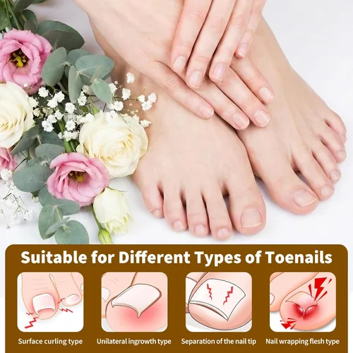 Miniatura 4 de Juego de corrector de uñas encarnadas con tiras correctoras y lima sin dolor, kit profesional de eliminación de uñas encarnadas con herramienta