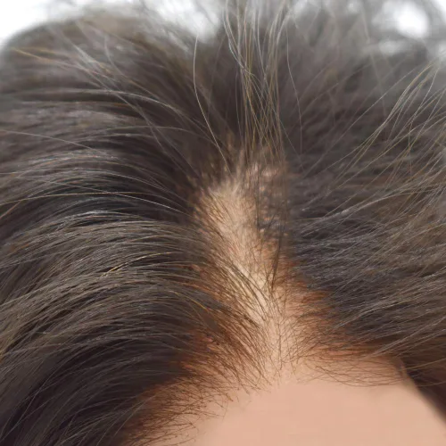 Miniatura 17 de Sistema de repuesto de cabello humano europeo con encaje frontal suizo para hombre, tupé para hombre, pieza de cabello, nudo blanqueado, línea #17