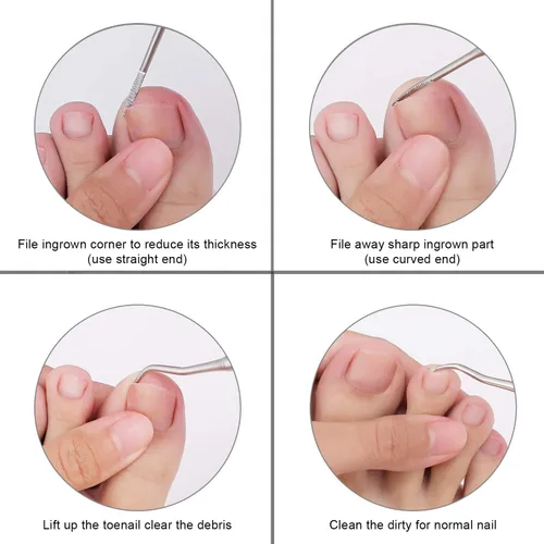 Miniatura 12 de YINYIN, 2 limas de uñas encarnadas y levantador con estuche de almacenamiento, herramienta de uñas encarnadas de acero inoxidable 100%, herramienta