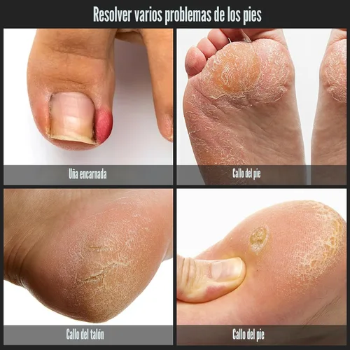 Miniatura 3 de Juego de 7 piezas para el tratamiento de uñas encarnadas, kit profesional de acero inoxidable para la extracción de uñas encarnadas, cortaúñas