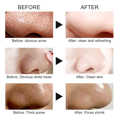 Miniatura 4 de Mascarilla para Puntos Negros Removedor, Mascarillas para La Cara Facial, Crema para Puntos Negros en La Cara, Removedor de Cabeza Blanca Negra