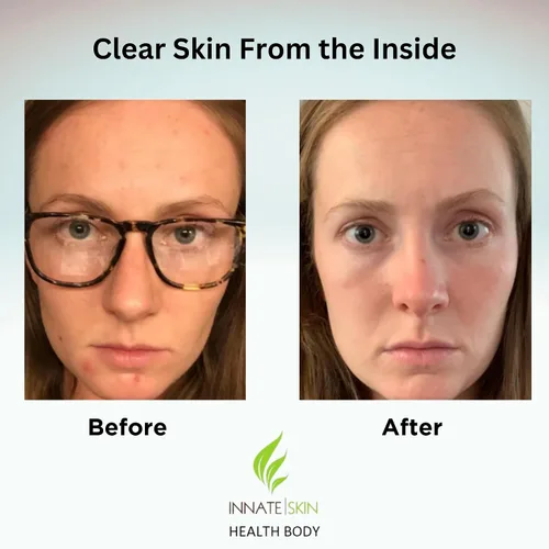 Miniatura 3 de Clear Skin - Paquete de vitaminas para el acné 20 antioxidantes, botánicos, minerales y vitaminas Pastillas hormonales y quísticas para el acné